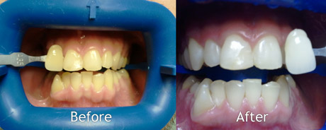 teeth whitening norwich